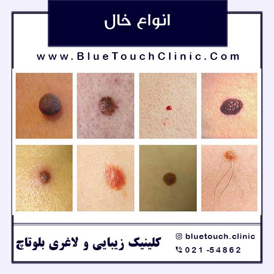 هزینه برداشتن خال،با جراحی و لیزر+فیلم لیزر خال